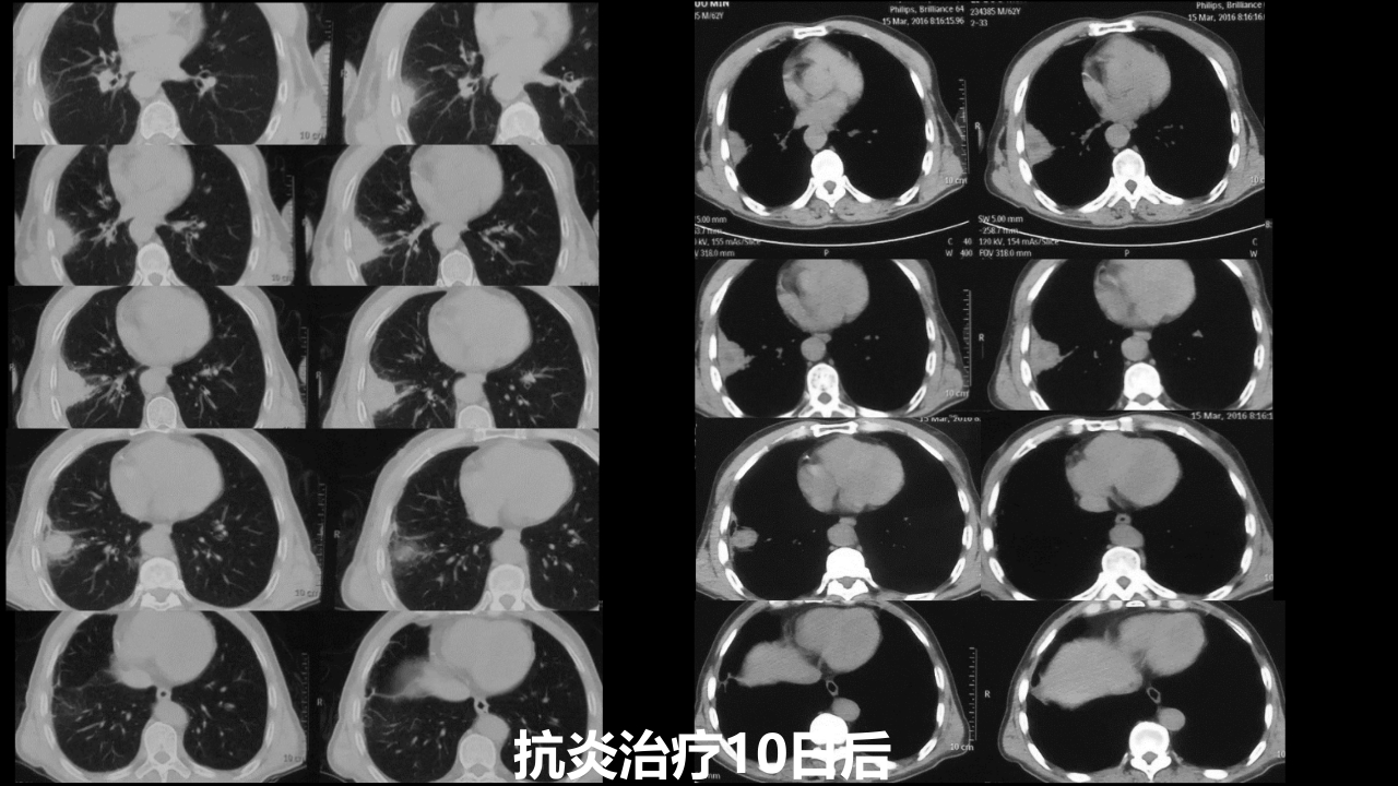 肺部肿块有效的影像检查选择