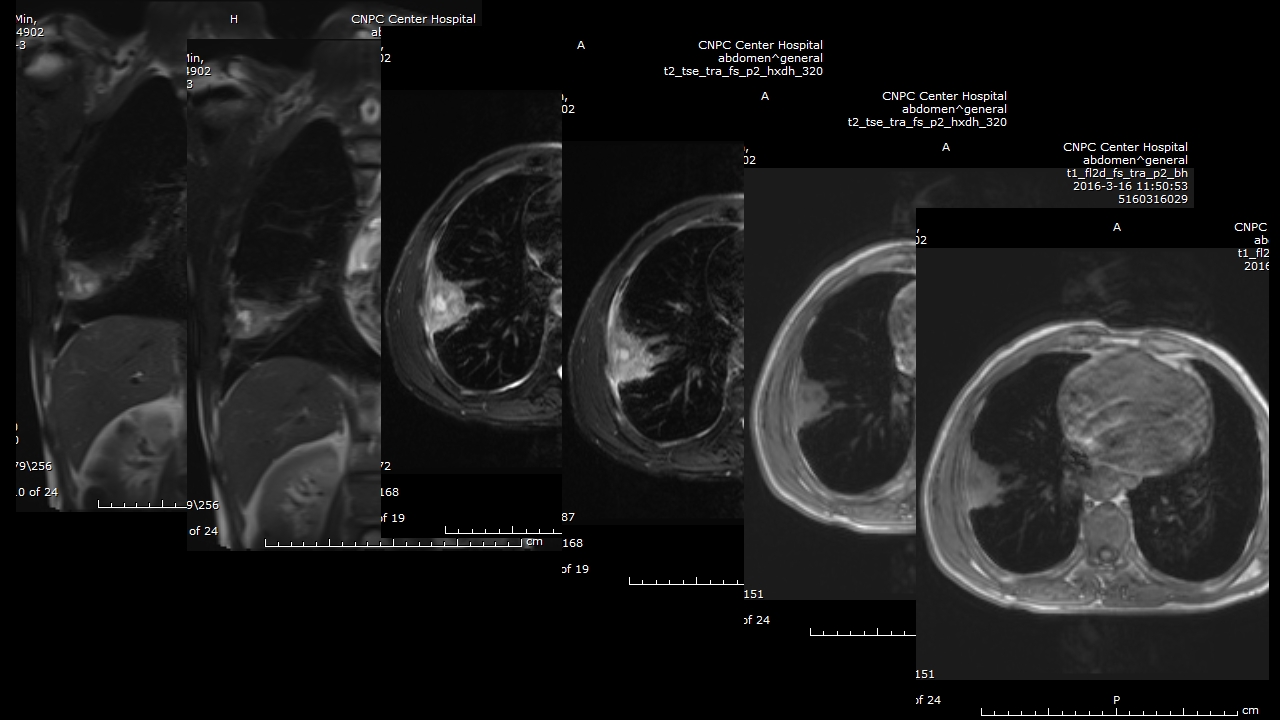 肺部肿块有效的影像检查选择