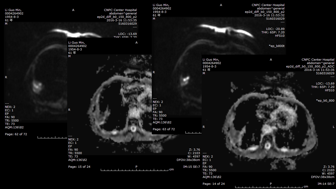肺部肿块有效的影像检查选择