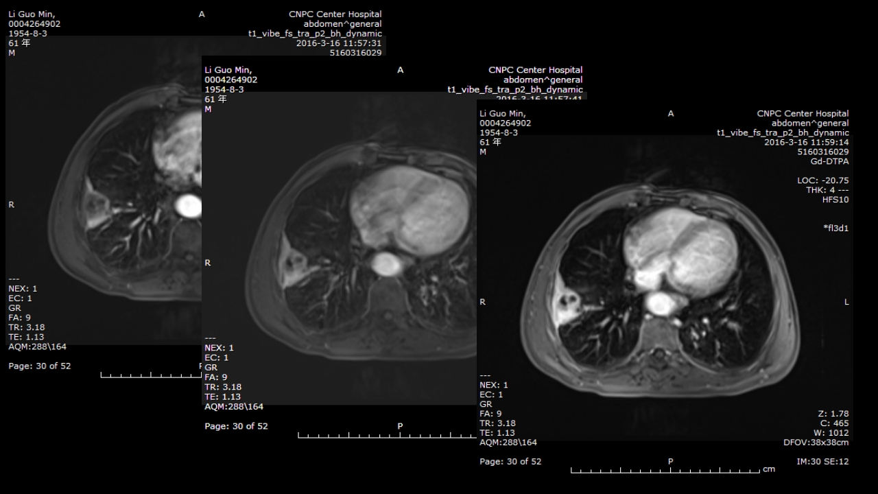 肺部肿块有效的影像检查选择