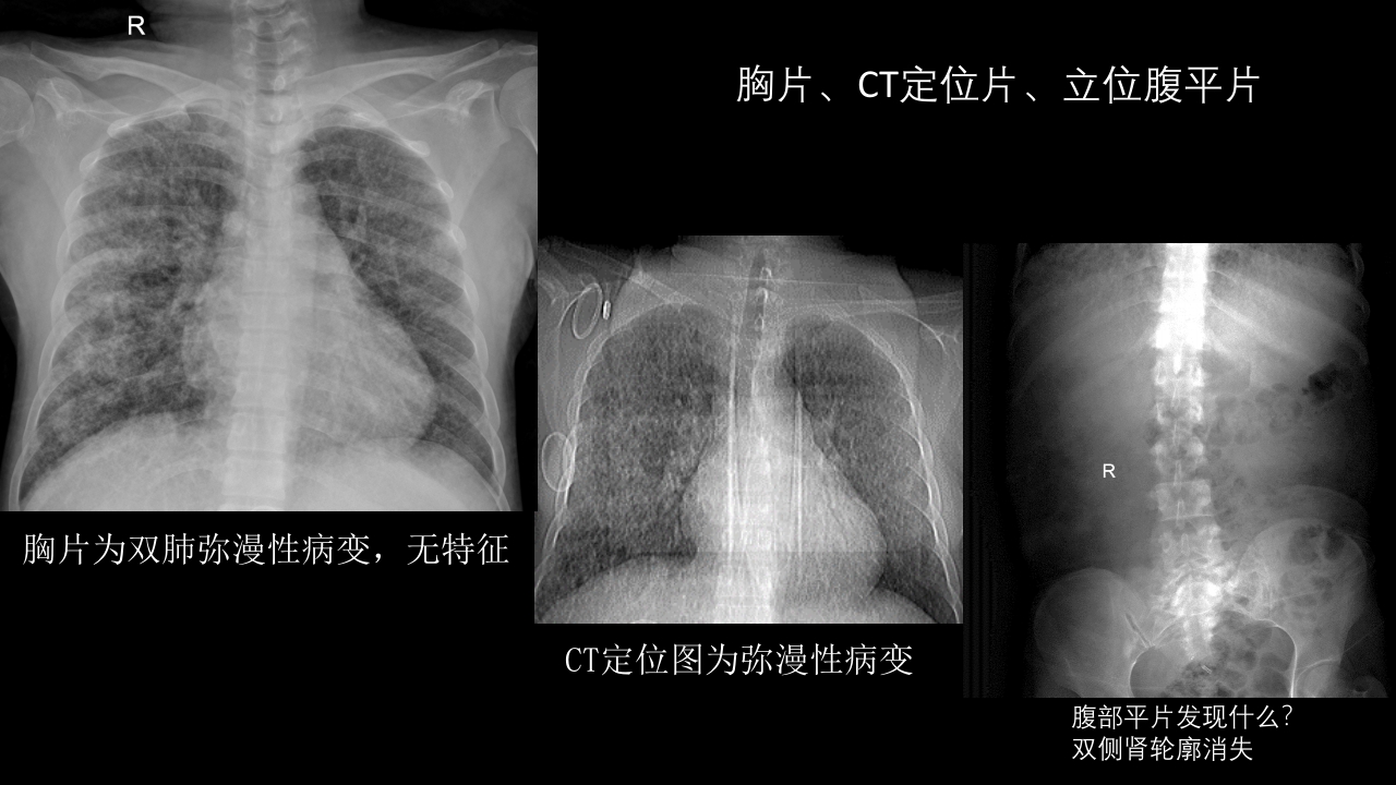 肺淋巴管肌瘤病合并双侧巨大肾血管平滑肌脂肪瘤(X线、CT、MR)