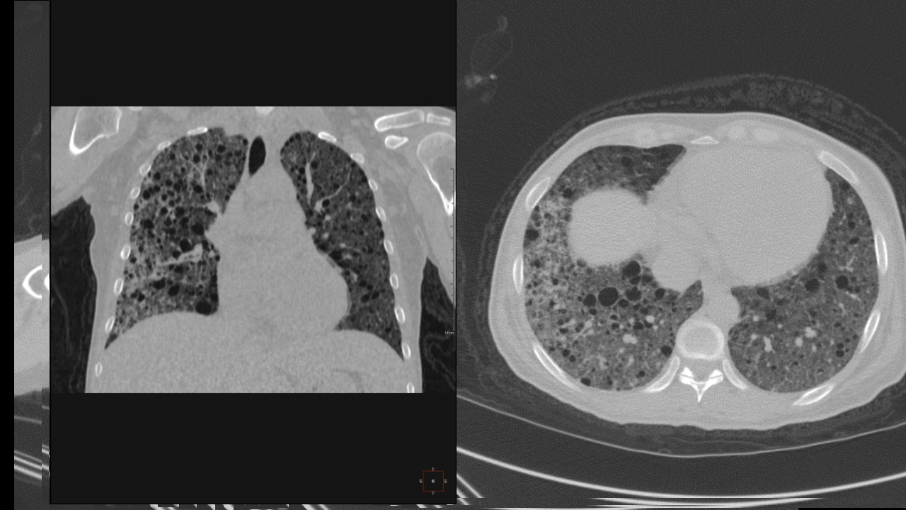 肺淋巴管肌瘤病合并双侧巨大肾血管平滑肌脂肪瘤(X线、CT、MR)