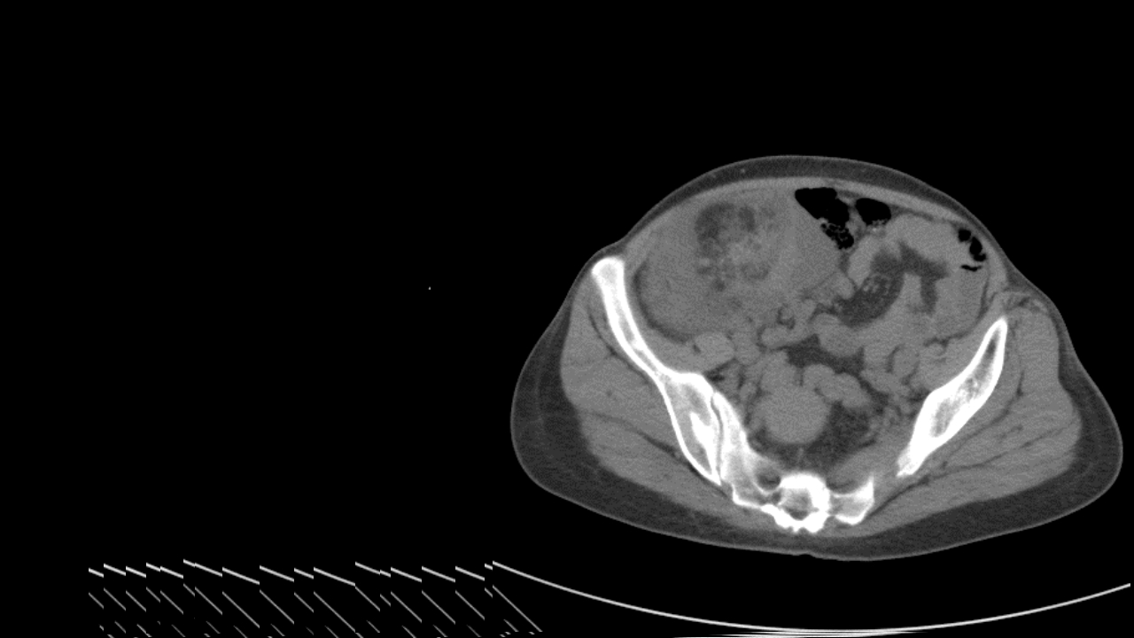 肺淋巴管肌瘤病合并双侧巨大肾血管平滑肌脂肪瘤(X线、CT、MR)