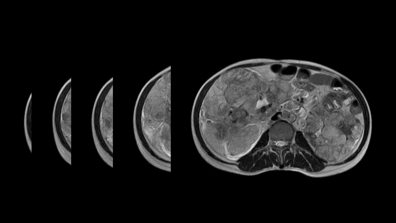 肺淋巴管肌瘤病合并双侧巨大肾血管平滑肌脂肪瘤(X线、CT、MR)