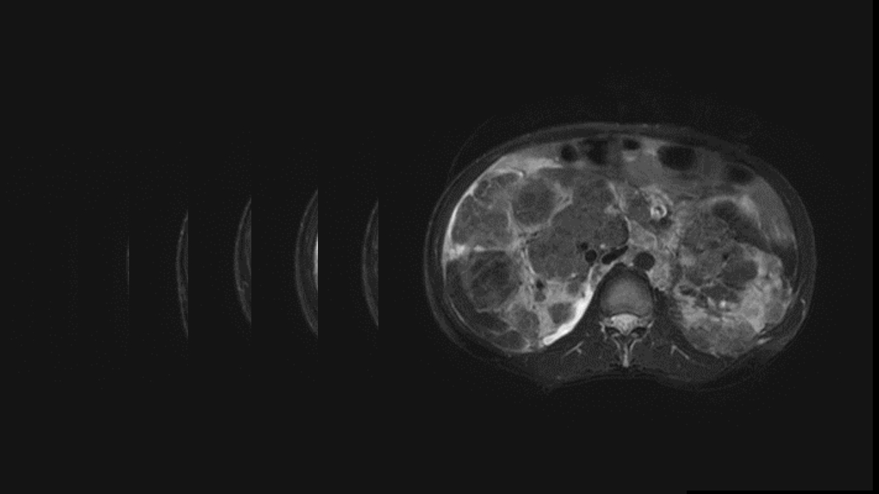 肺淋巴管肌瘤病合并双侧巨大肾血管平滑肌脂肪瘤(X线、CT、MR)