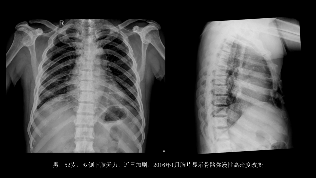 氟骨症的X线CT及MR影像及解读