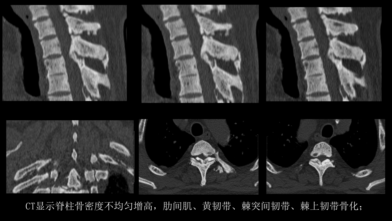 氟骨症的X线CT及MR影像及解读