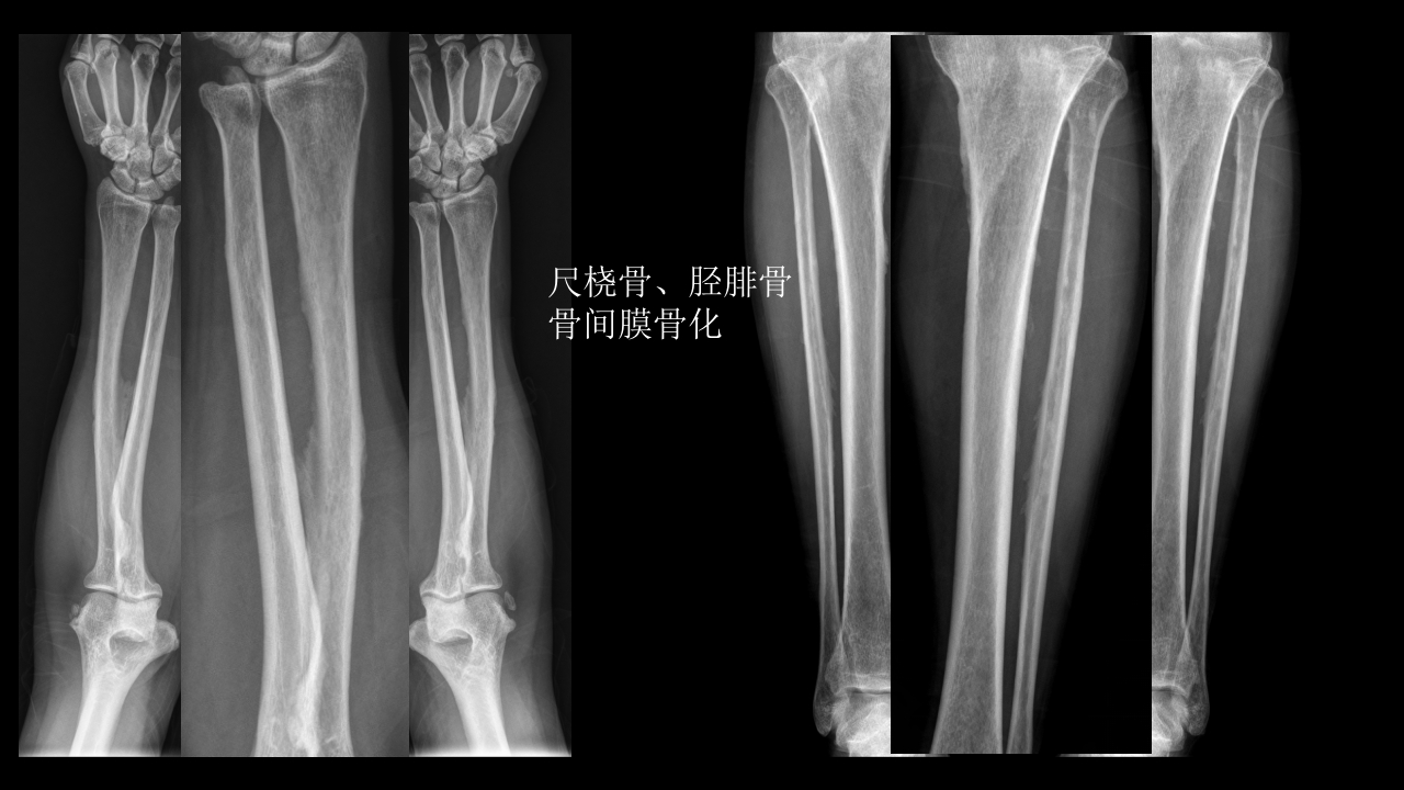 氟骨症的X线CT及MR影像及解读