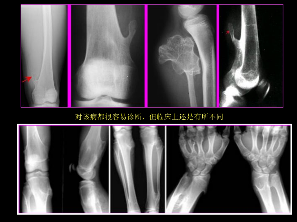 骨肿瘤影像学诊断