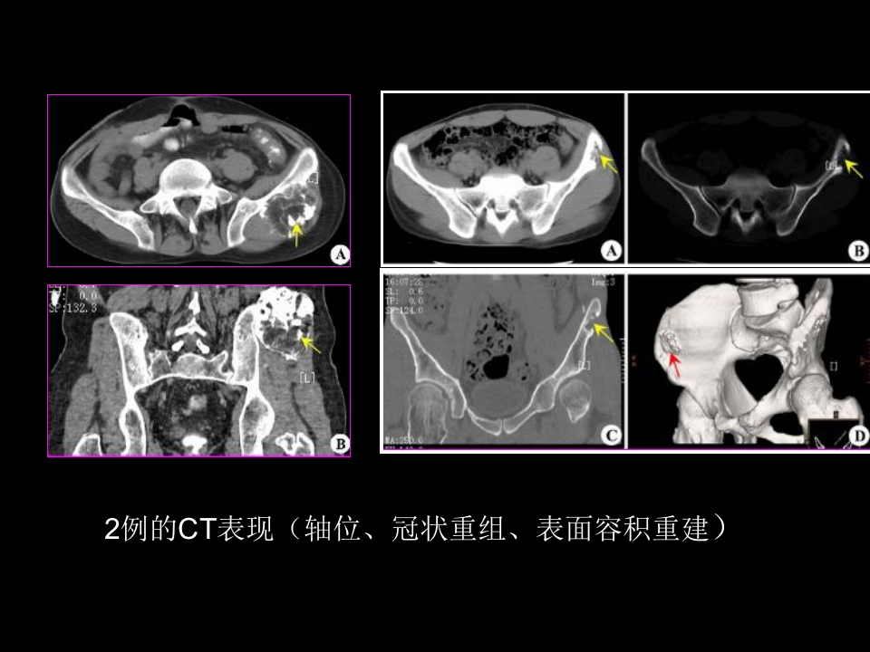 骨肿瘤影像学诊断