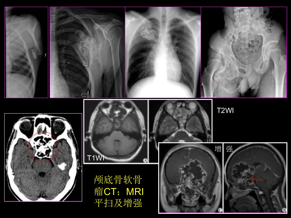 骨肿瘤影像学诊断