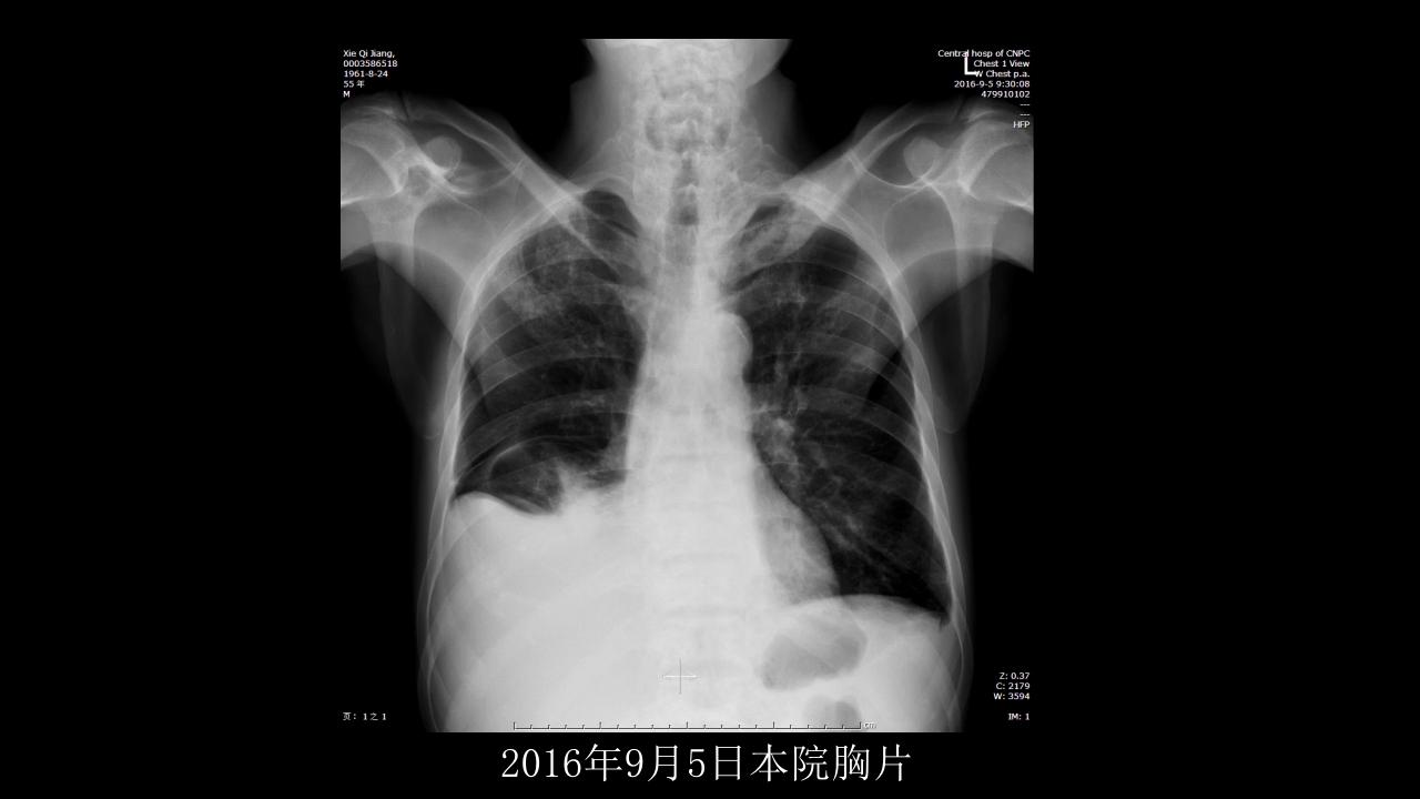 没有见过的弥漫性的骨质破坏