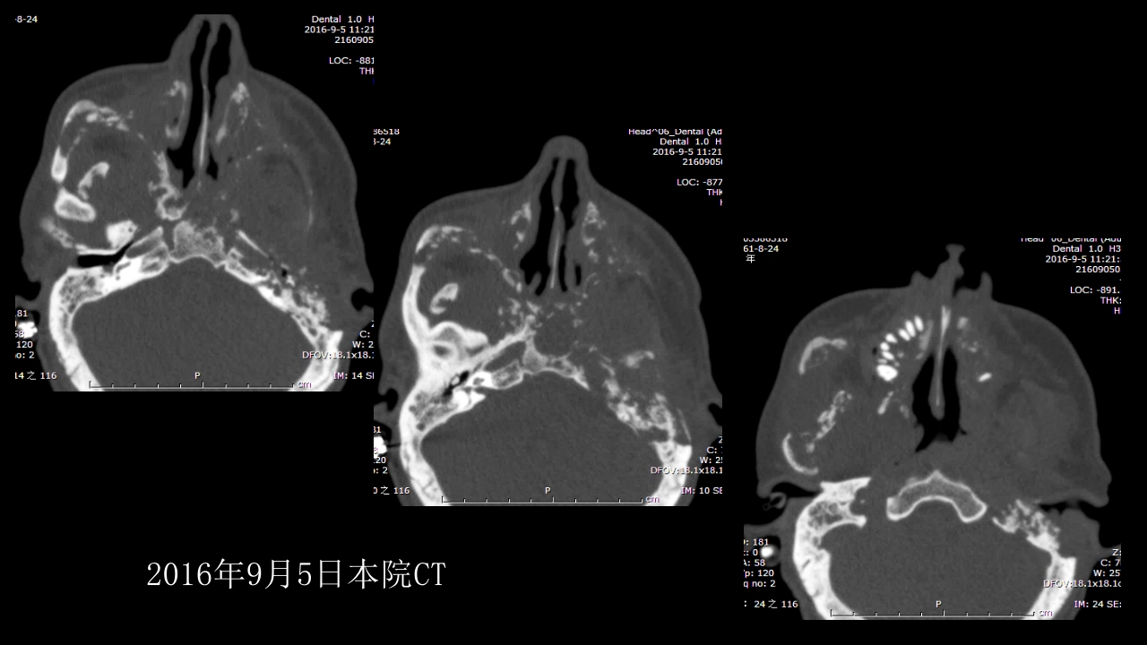 没有见过的弥漫性的骨质破坏