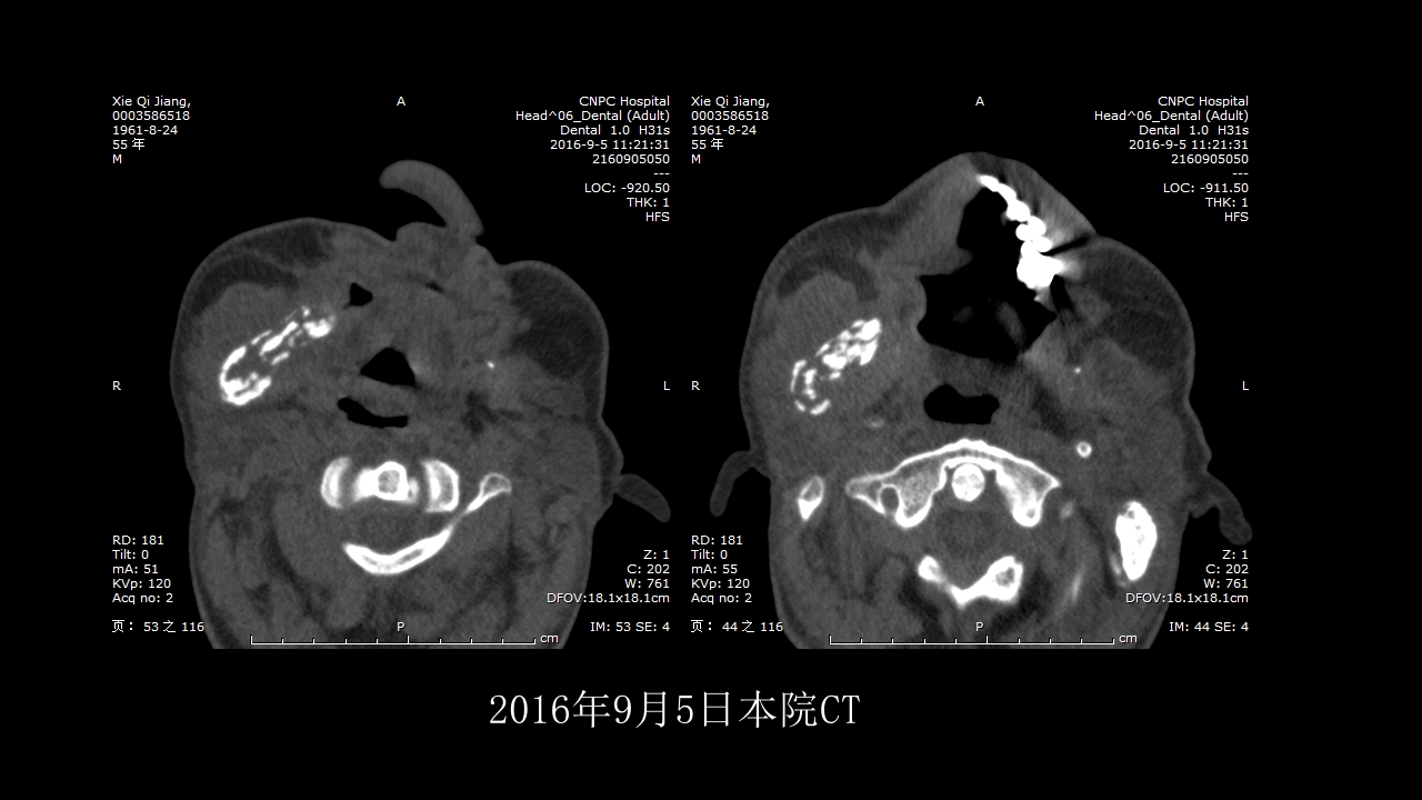 没有见过的弥漫性的骨质破坏