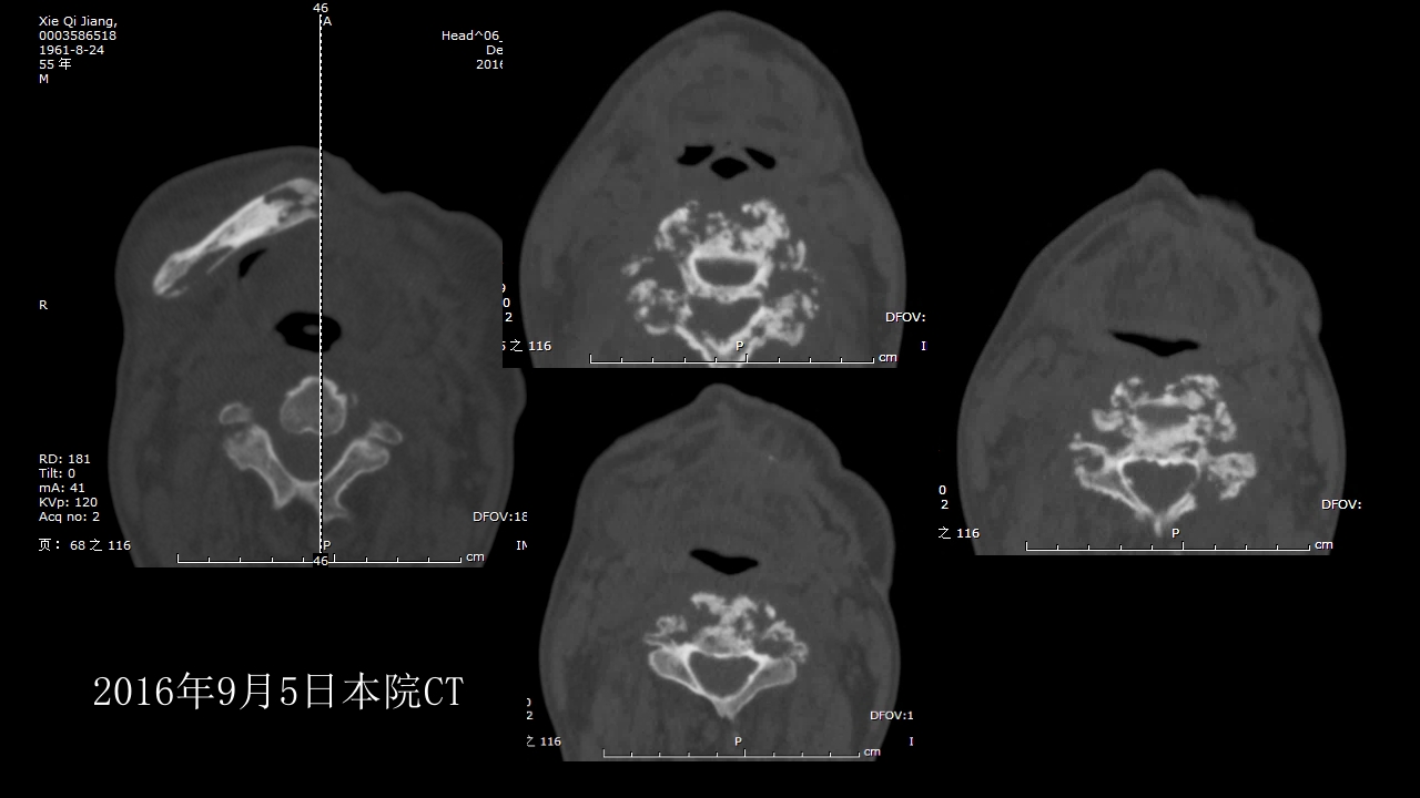 没有见过的弥漫性的骨质破坏