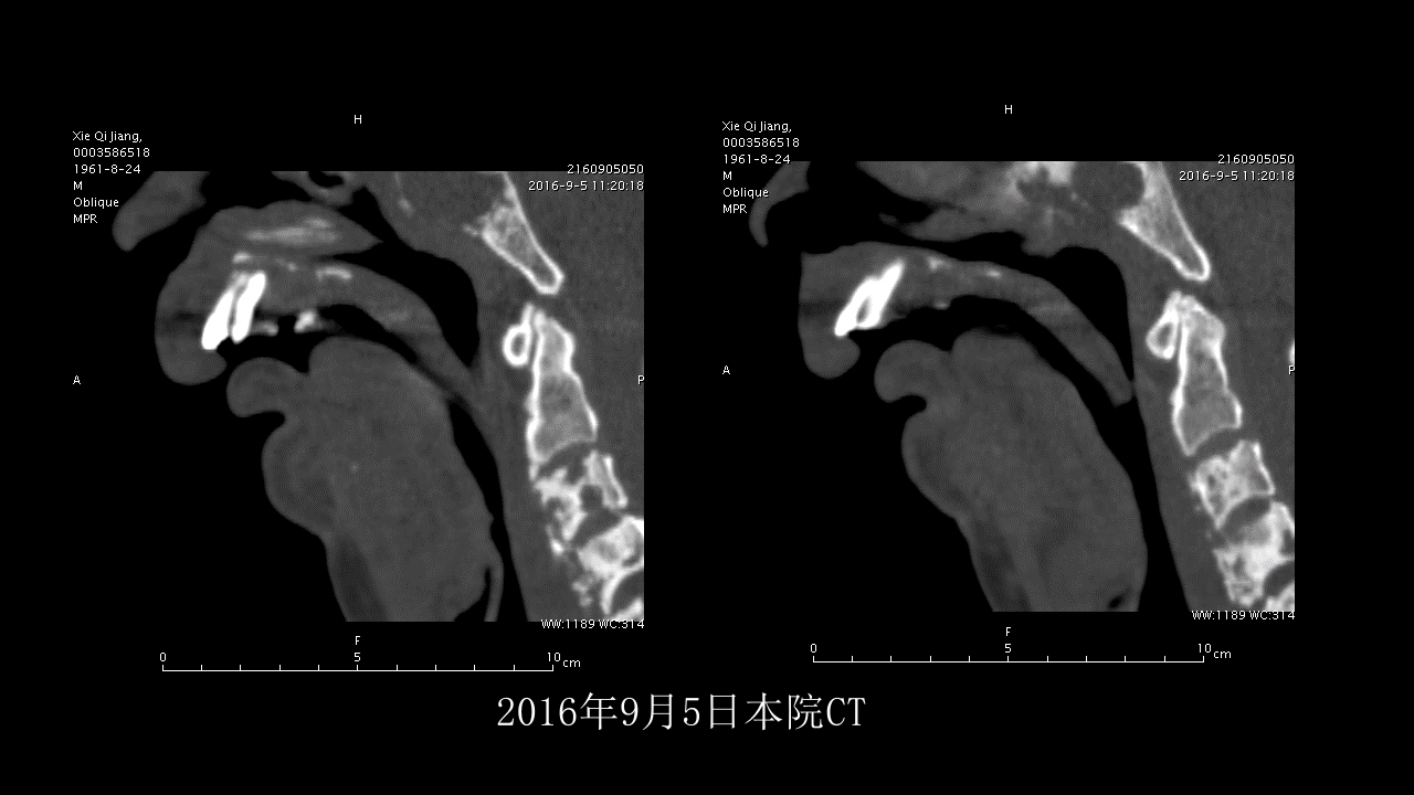 没有见过的弥漫性的骨质破坏