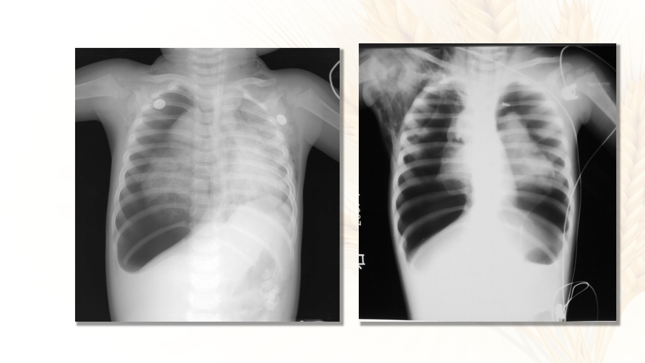 儿科呼吸系统急症应急处理流程