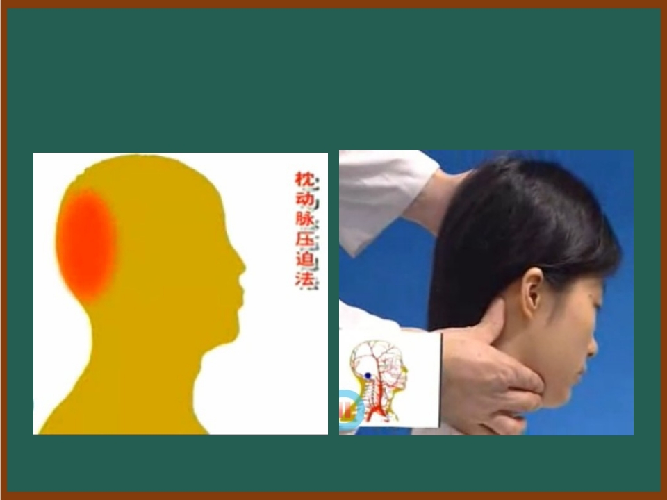 开放性伤口的止血包扎技术