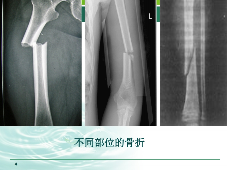 外伤止血、包扎、固定、搬运