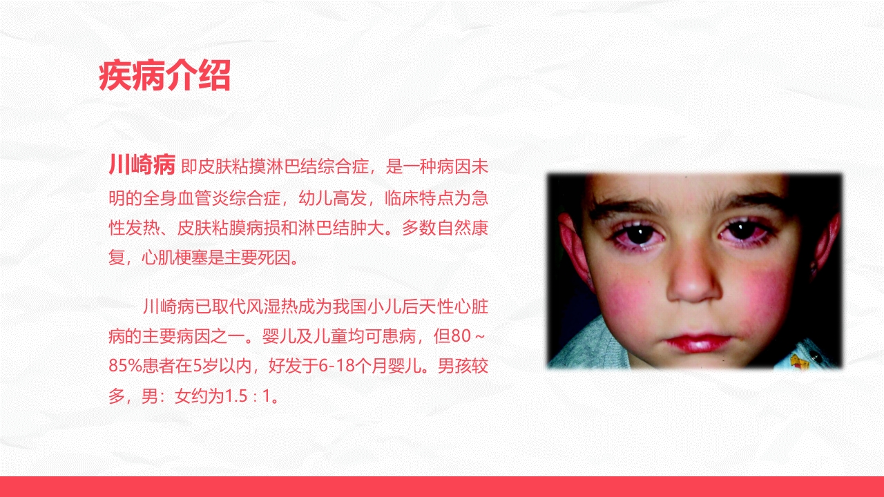 川崎病儿科护理进展