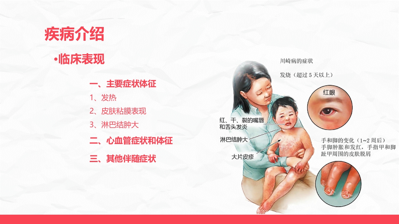 川崎病儿科护理进展