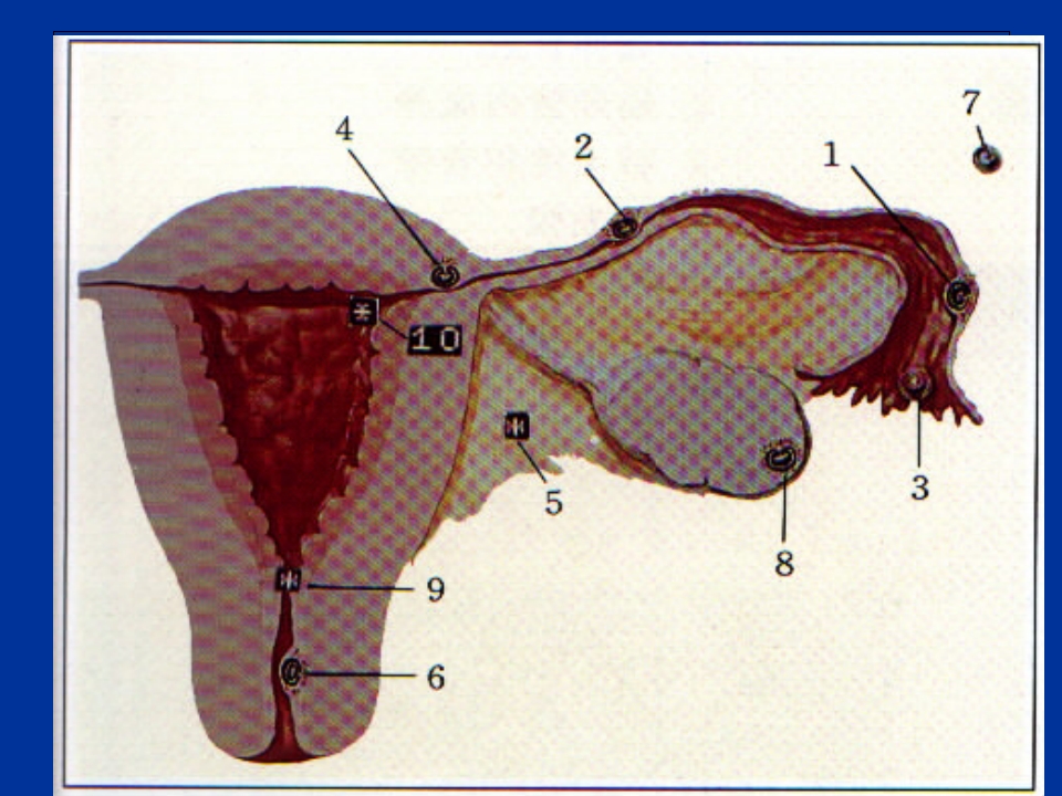 异位妊娠失血性休克的急救与护理
