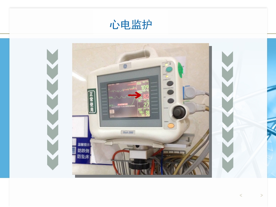 NPPV人机对抗个案护理