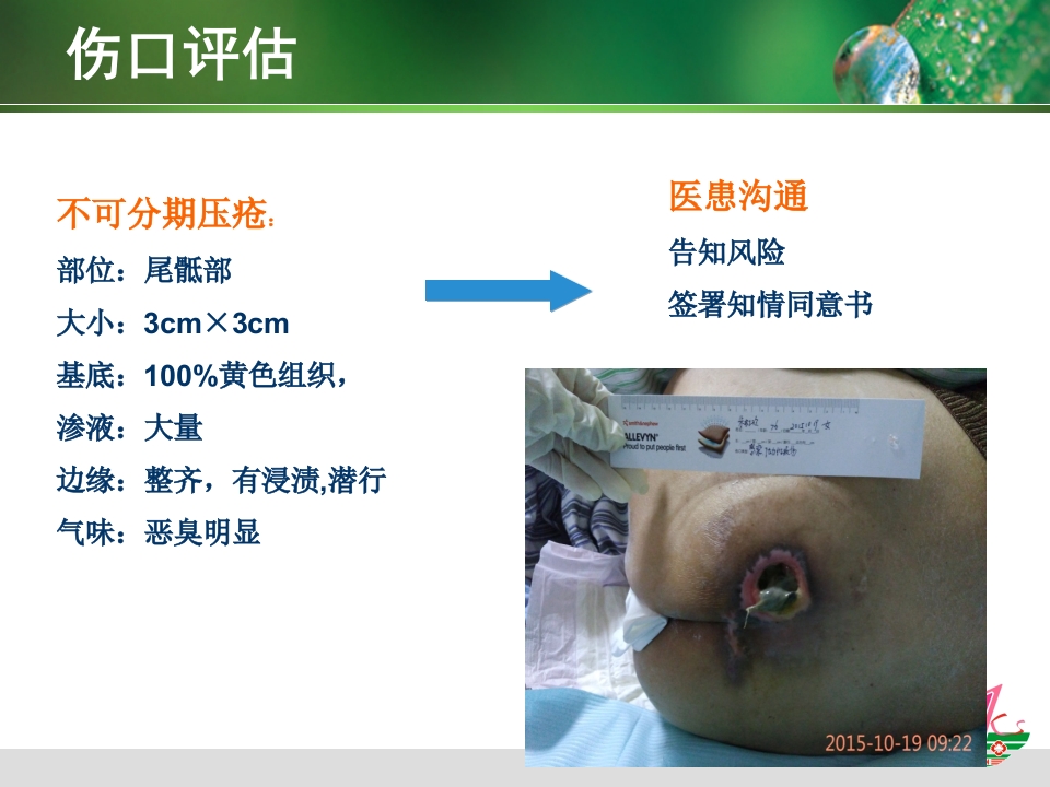负压治疗一例合并感染Ⅳ期压疮患者的护理体会
