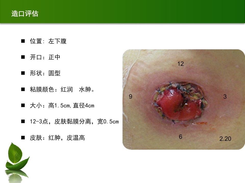 结肠肠造口术后皮肤黏膜分离个案护理