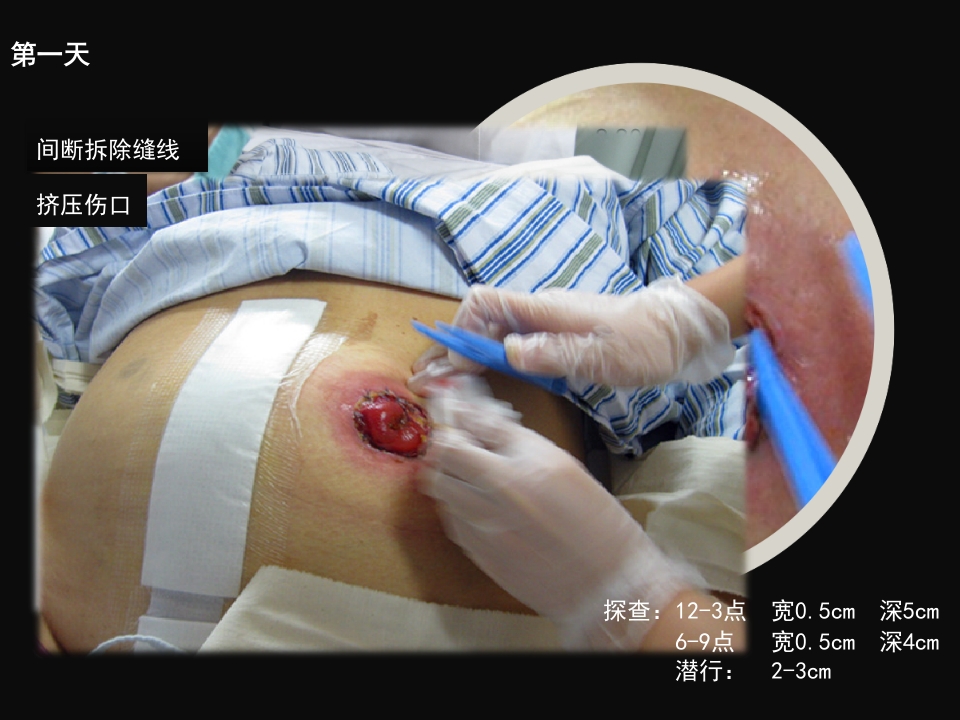 结肠肠造口术后皮肤黏膜分离个案护理