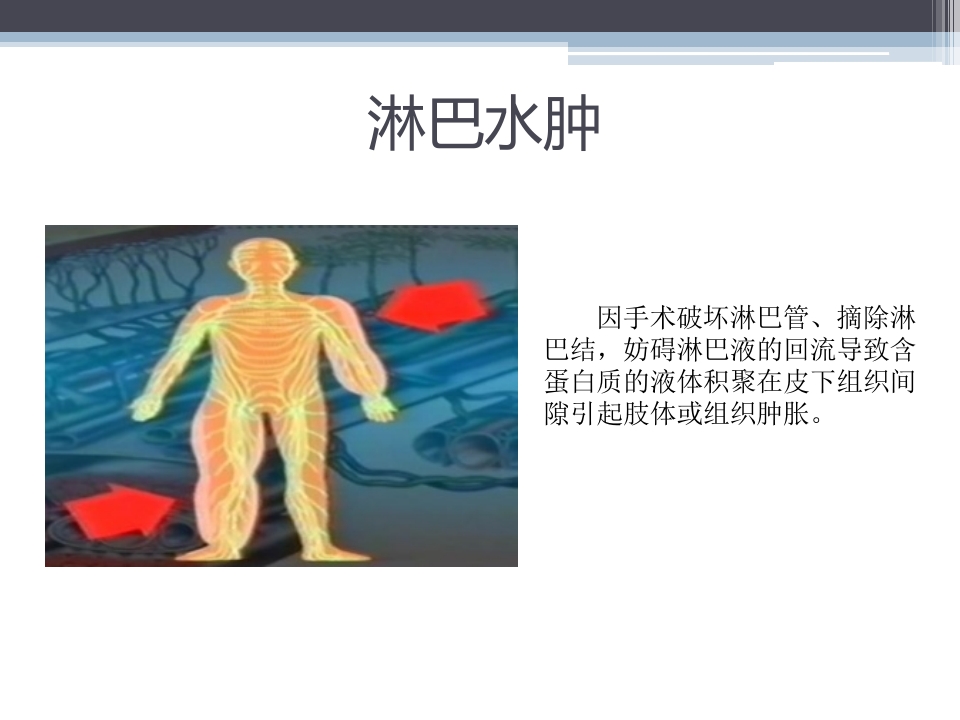 淋巴水肿的护理体会