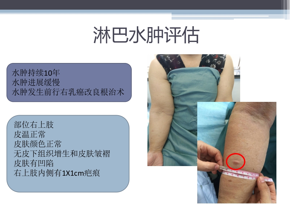 淋巴水肿的护理体会