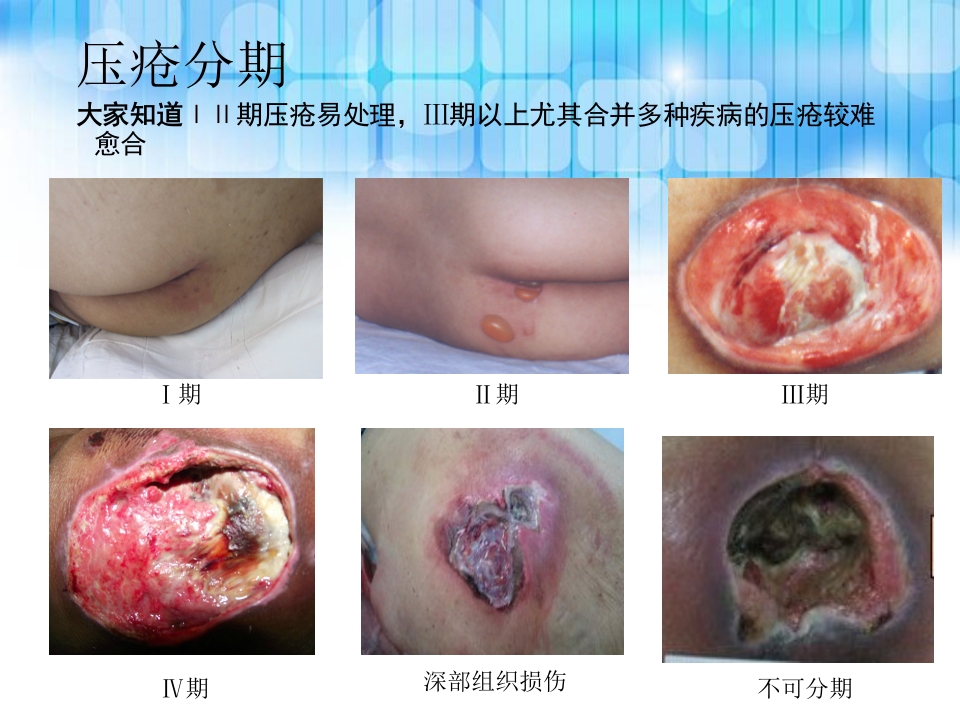 压疮个案护理查房