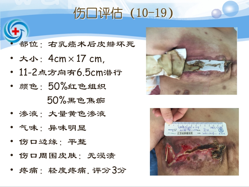 一案乳腺癌术后皮瓣坏死患者的处理