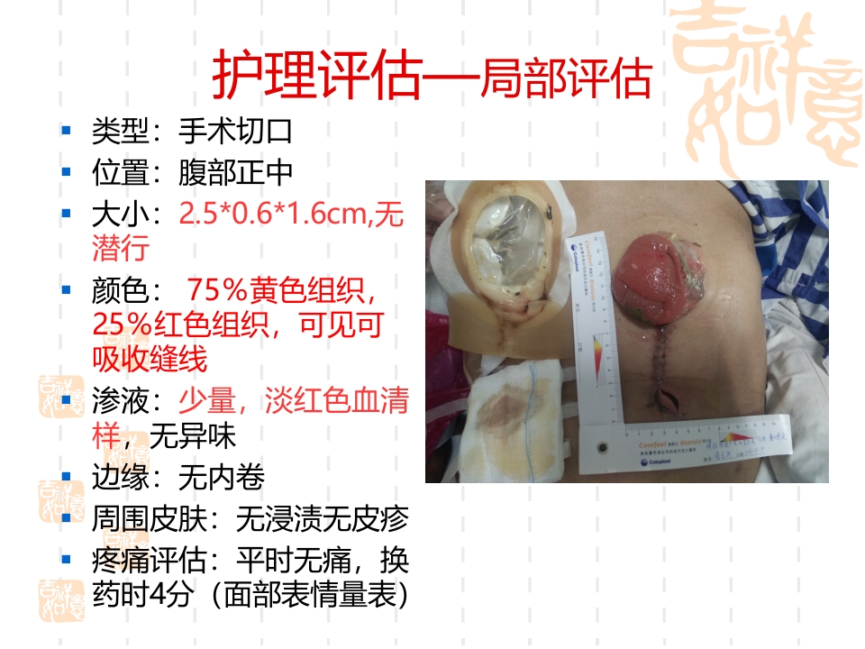 一例横结肠造口术后腹部切口裂开患者的护理