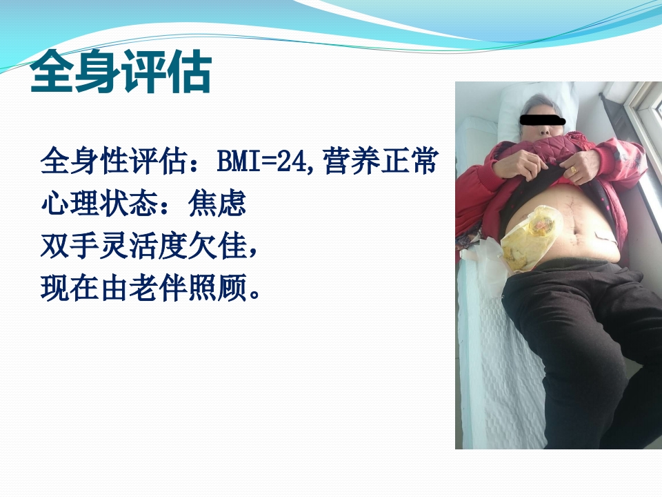 一例回肠造口周围皮肤并发症患者护理