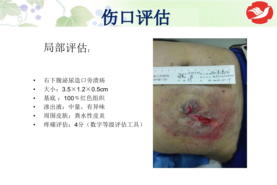 一例泌尿造口患者的护理