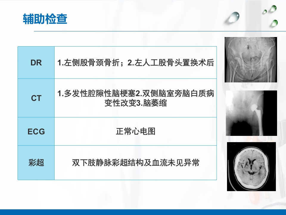 一例脑梗塞合并股骨头置换术后康复期患者的个案护理