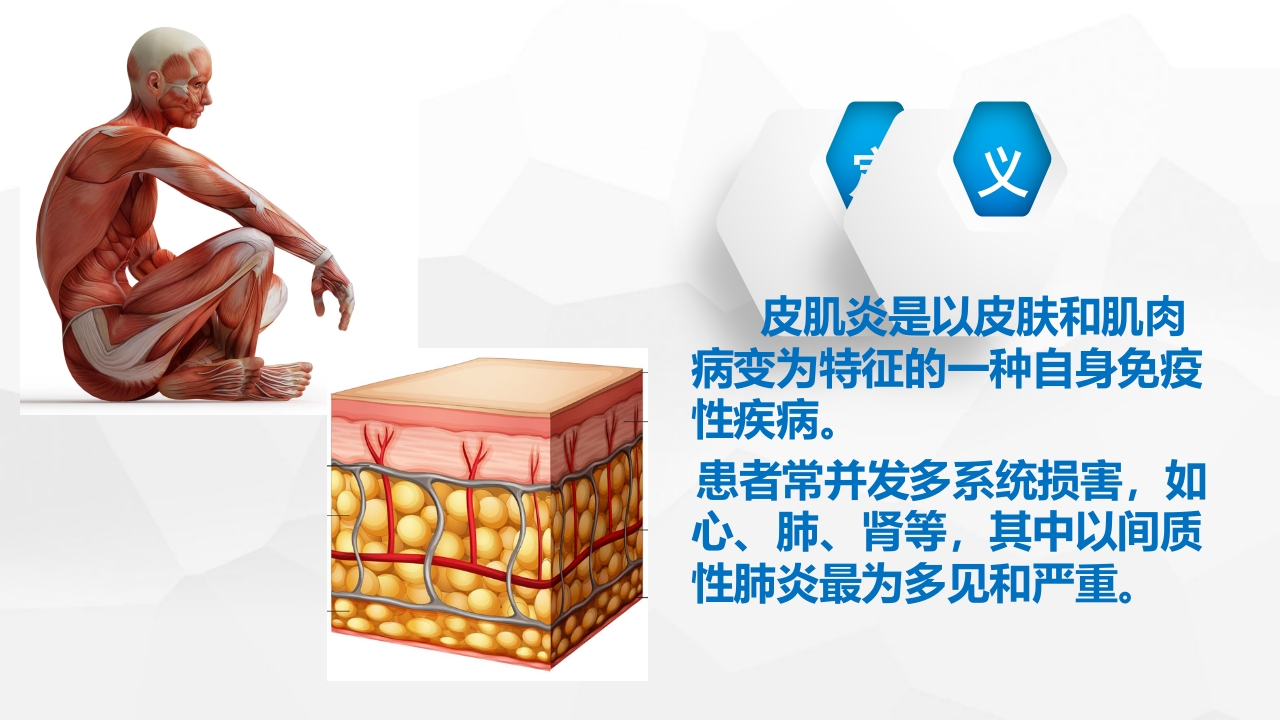 一例皮肌炎合并间质性肺炎