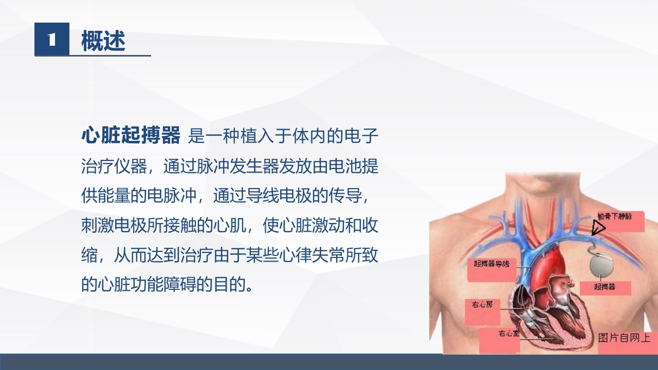 永久起搏器的业务学习