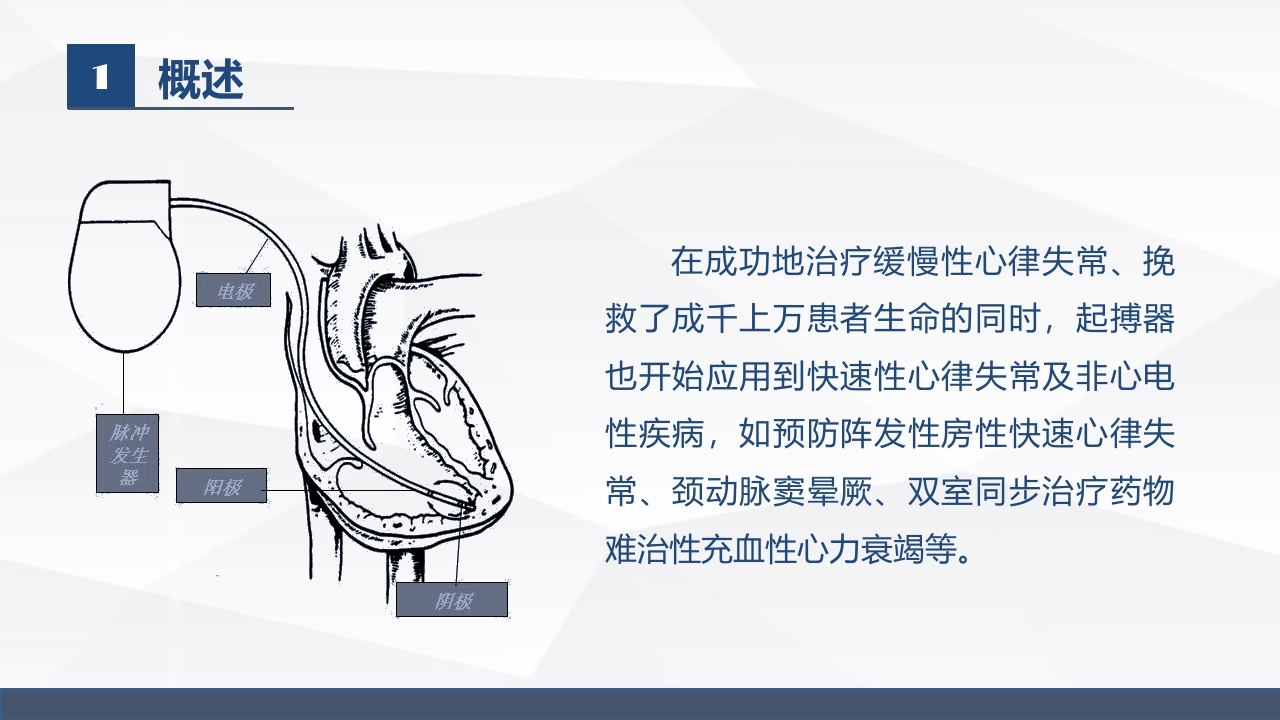 永久起搏器的业务学习