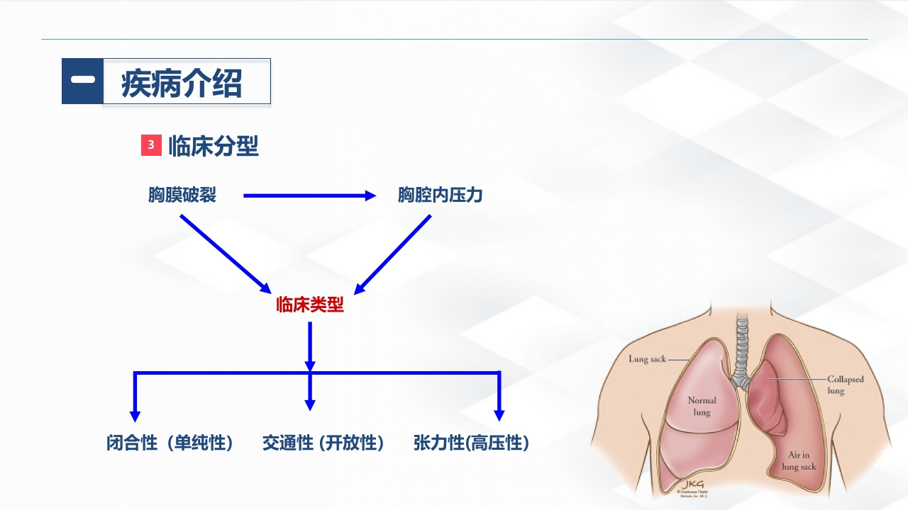 结核病科-结核性胸膜炎患者自发性气胸的护理查房