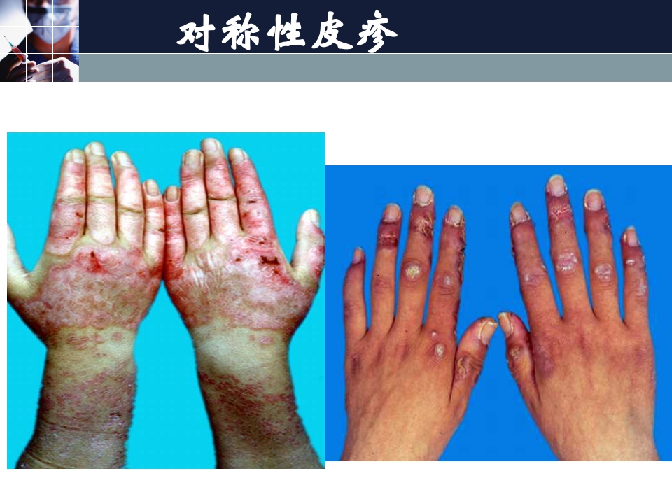 狼疮性肾炎的护理常规ppt