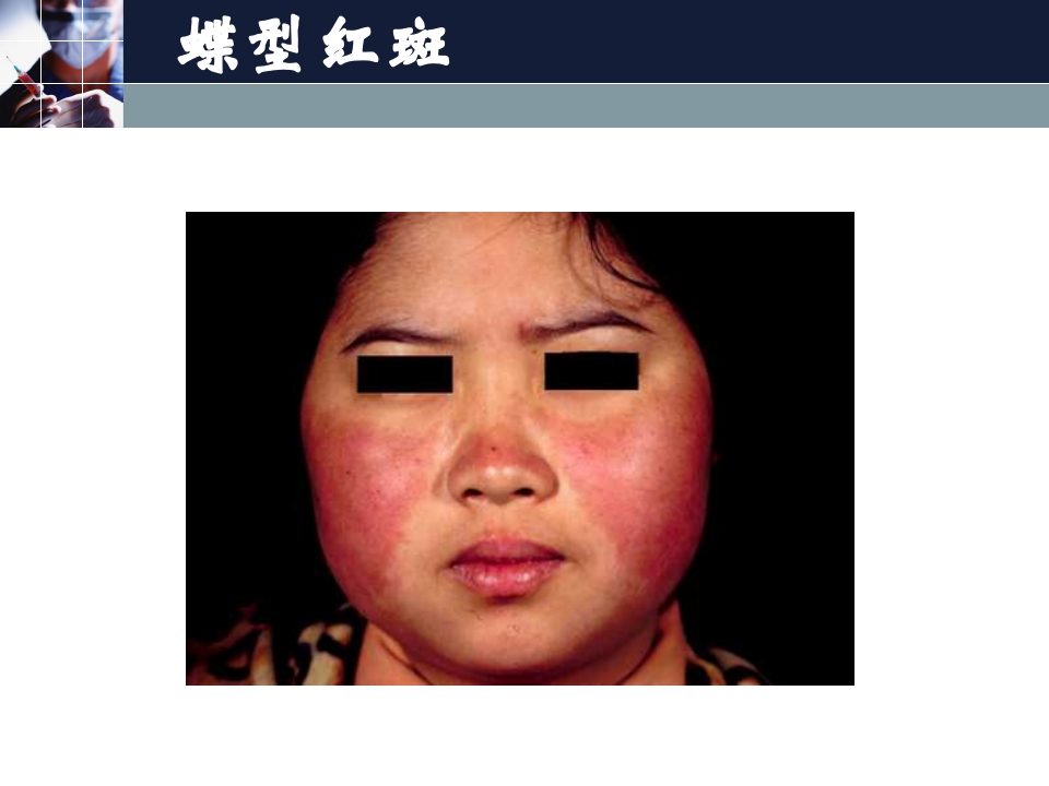 狼疮性肾炎的护理常规ppt