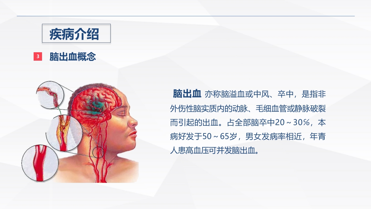脑出血疾病介绍+术后护理