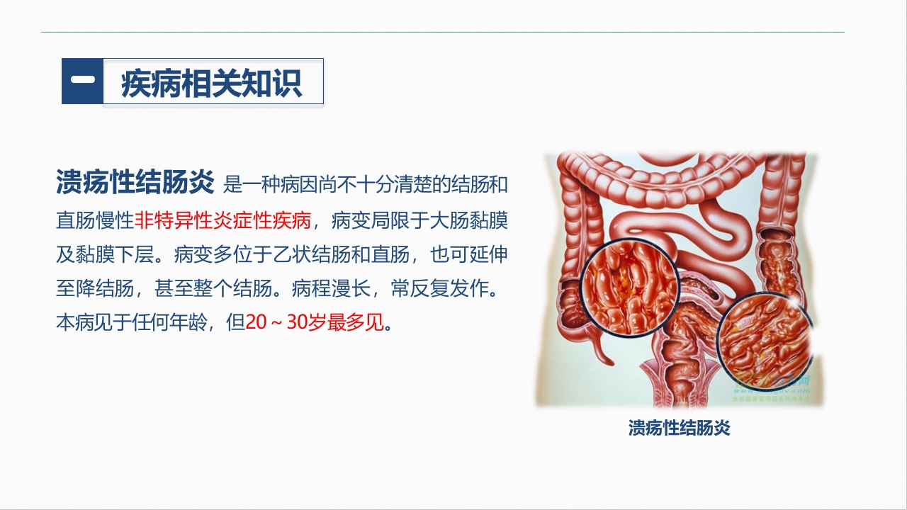 消化内科-溃疡性结肠炎护理查房