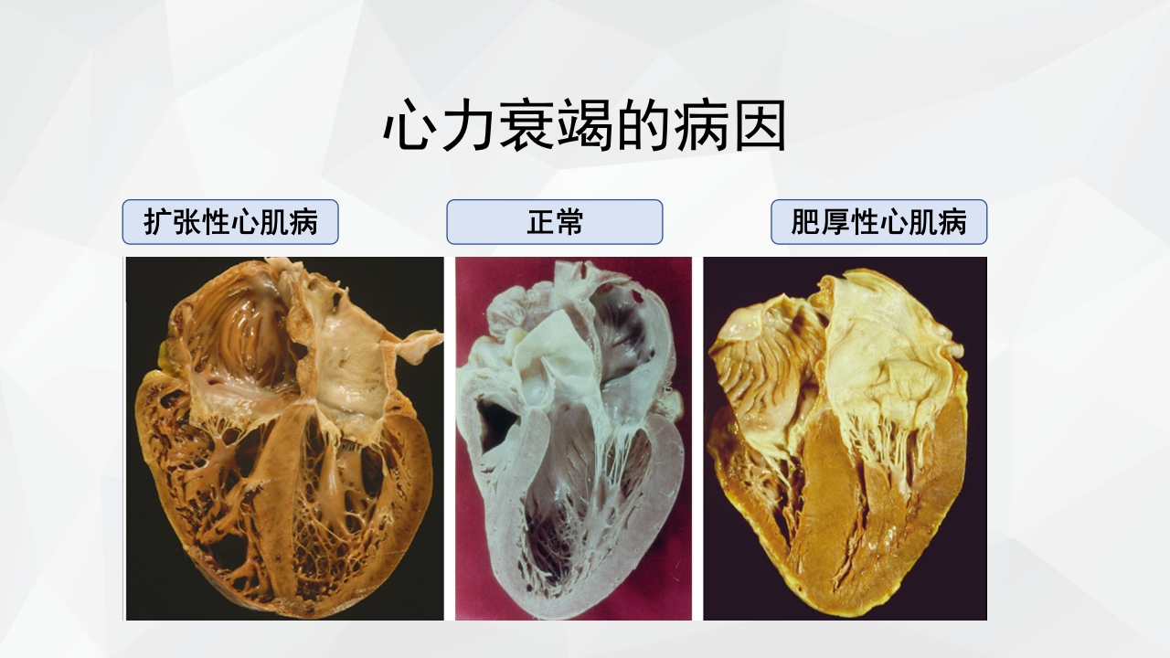 心力衰竭护理查房