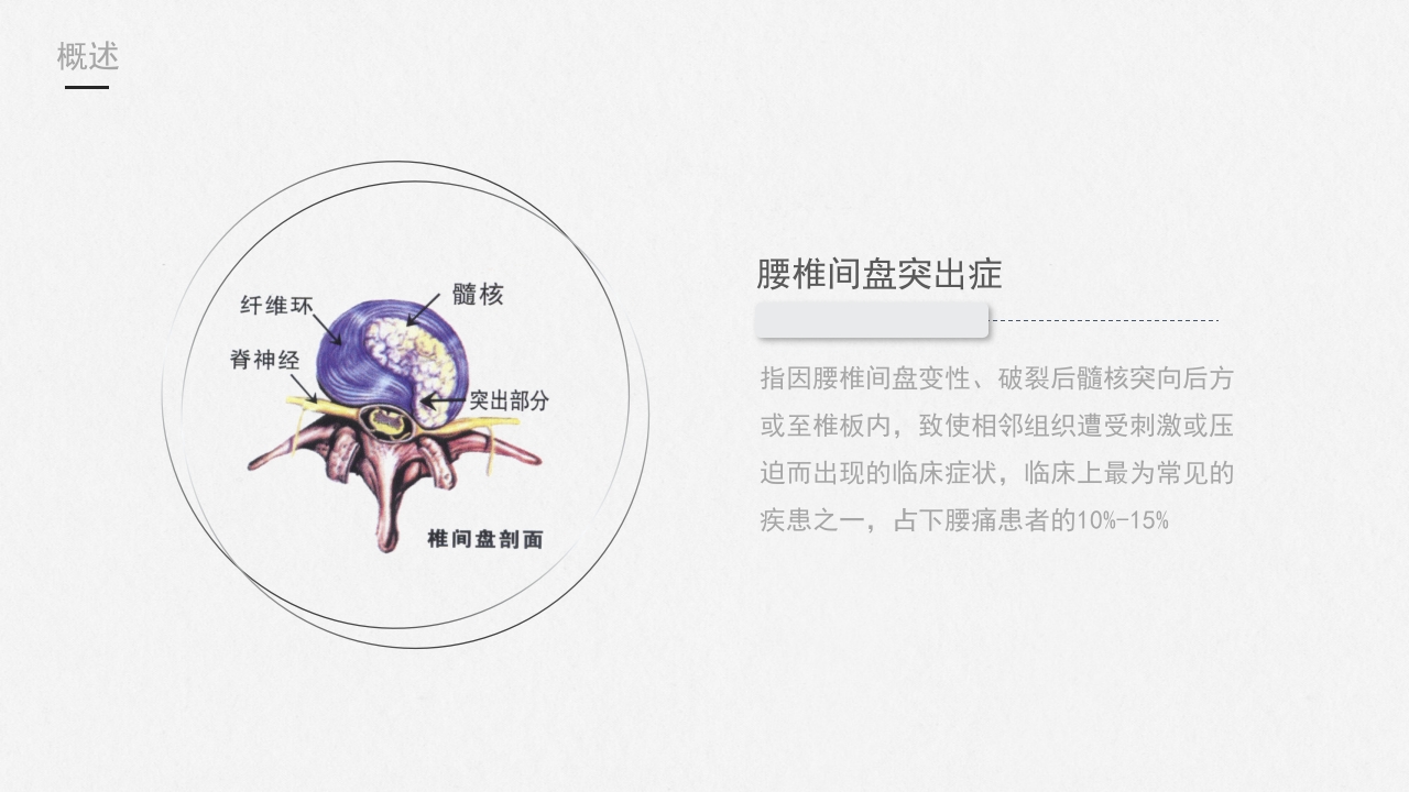 腰椎间盘突出症护理查房-模板参考