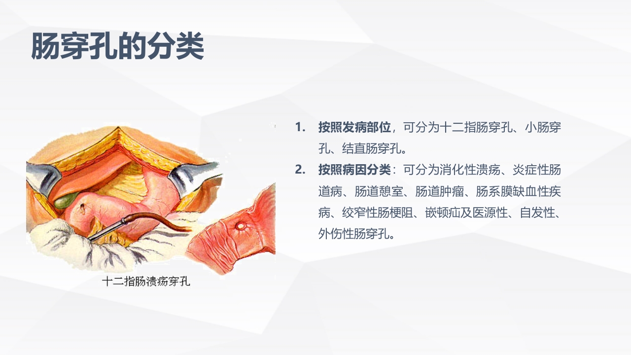 肠穿孔的护理学习