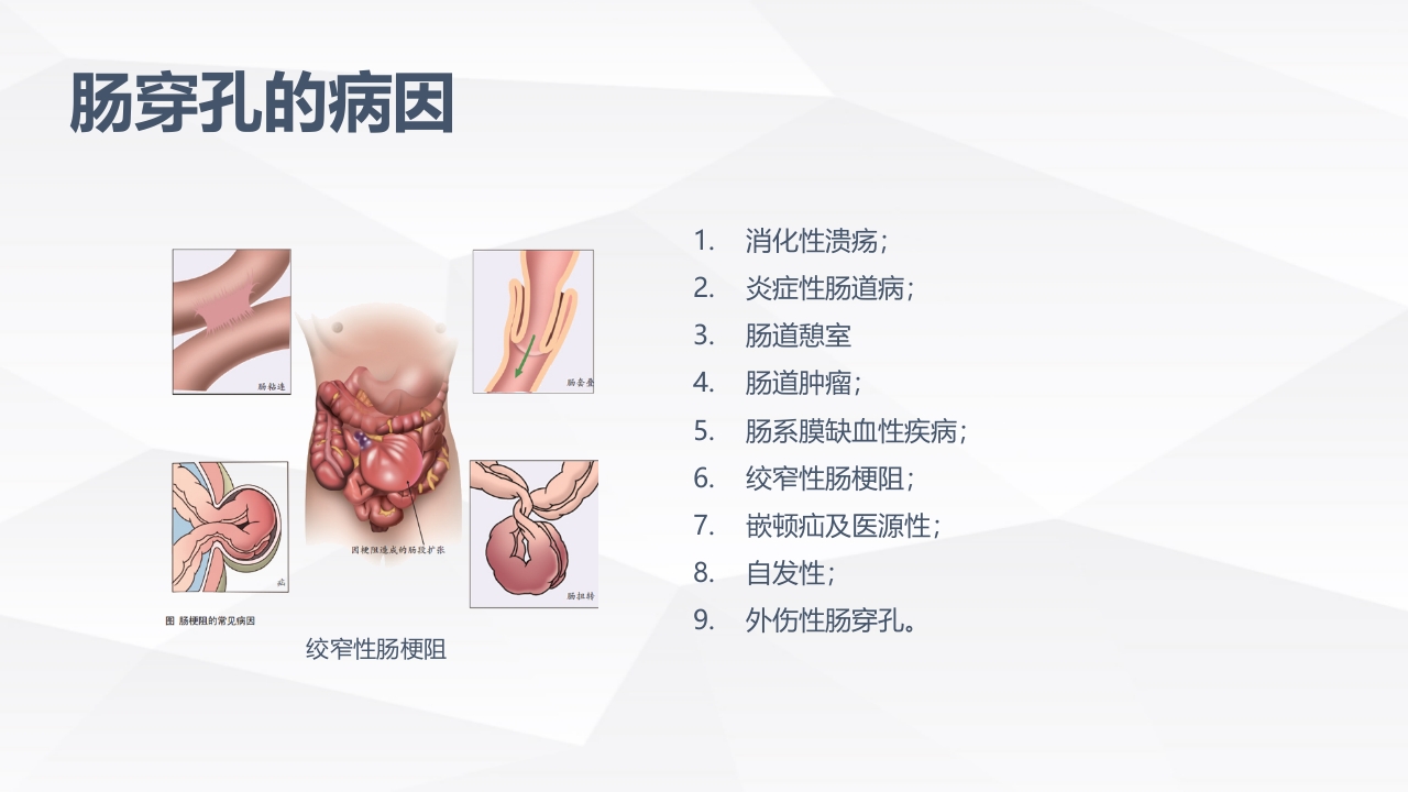 肠穿孔的护理学习